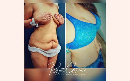 Breast Augmentation: Implants or Fat Transfer?