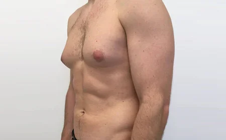 How the OCCULT Technique Is Changing Gynecomastia Treatment?