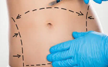 هل يمكن الحمل بعد عملية شد البطن؟