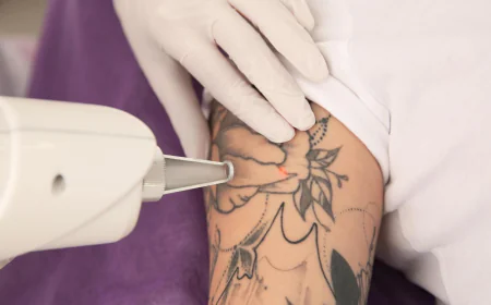 Myths About Tattoo Removal in Islamabad That You Should Stop Believing