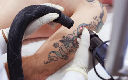 How Many Sessions Are Required for Full Tattoo Removal?