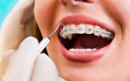 What Are Self-Ligating Braces?