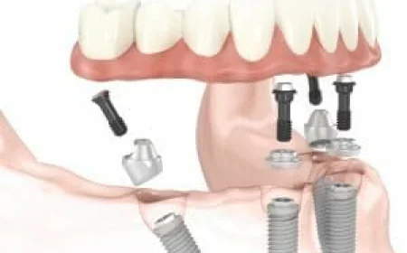 Long-Term Solutions for Missing Teeth with Implant-Supported Dentures