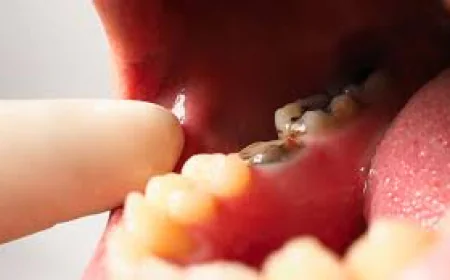 Root Canal on Back Teeth: Common Patient Questions