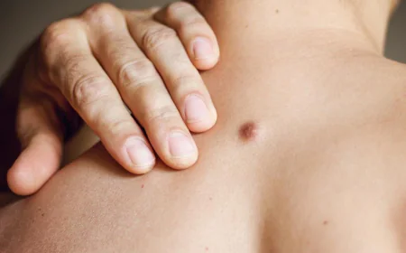 How Do Dermatologists Perform Skin Tag Removal in Dubai?