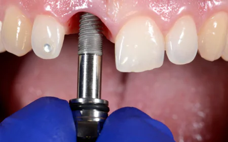 Does an Implant Infection Affect Bone Health?