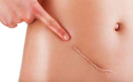 How Long Does Wart Removal Usually Take?