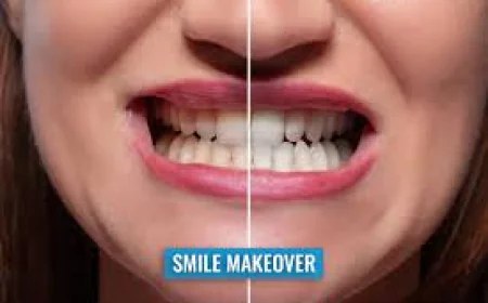 Transform Your Smile With a Complete Smile Makeover