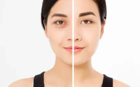 Can PRP Therapy Treat Stubborn Dark Circles?