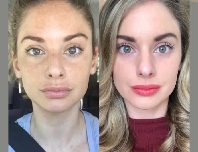 Premium Skin Tightening Experience with Radiofrequency (RF) Microneedling by the Best Aesthetic Clinic in Dubai
