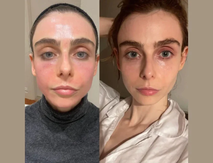 Radiofrequency (RF) Microneedling Treatment in Dubai Skin Rejuvenation Treatment