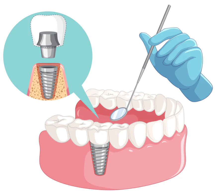 Finding the Right Dental Implant Specialist in London: A Path to Restored Confidence
