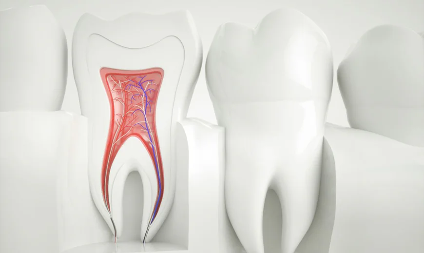 Root Canal Treatment for Infected Teeth in Islamabad