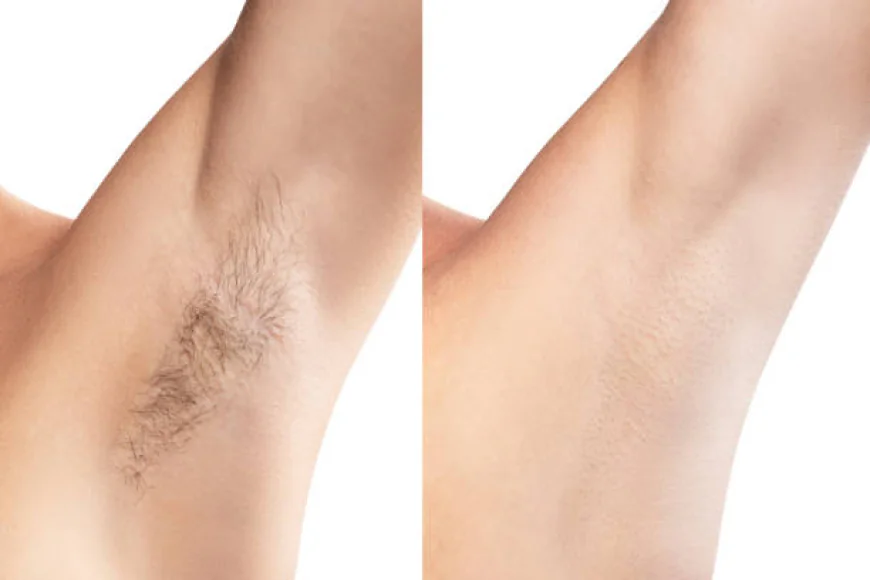Laser Hair Removal Results in Riyadh