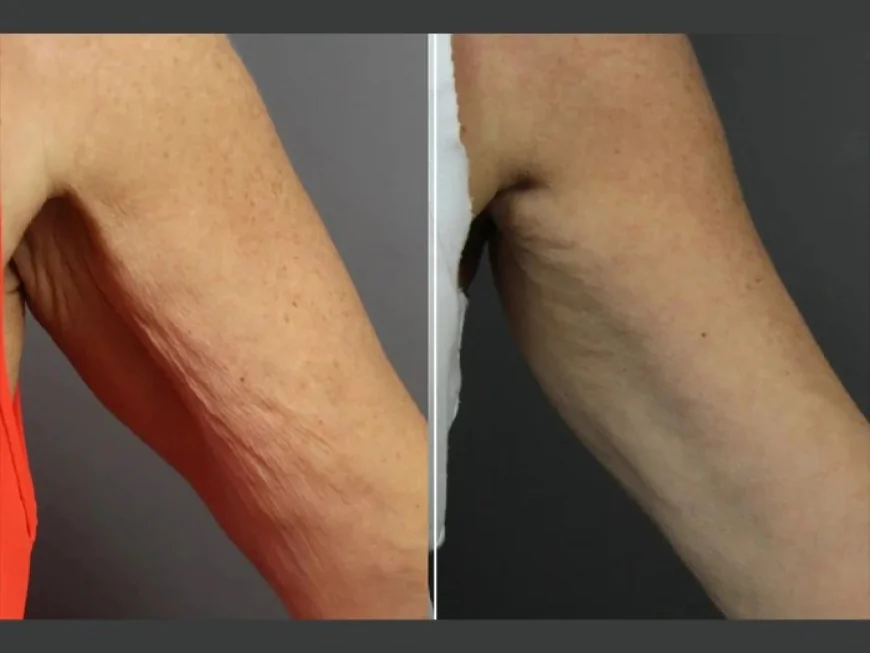 The Gold Standard of Moxi Laser Treatment at the Best Aesthetic Clinics in dubai
