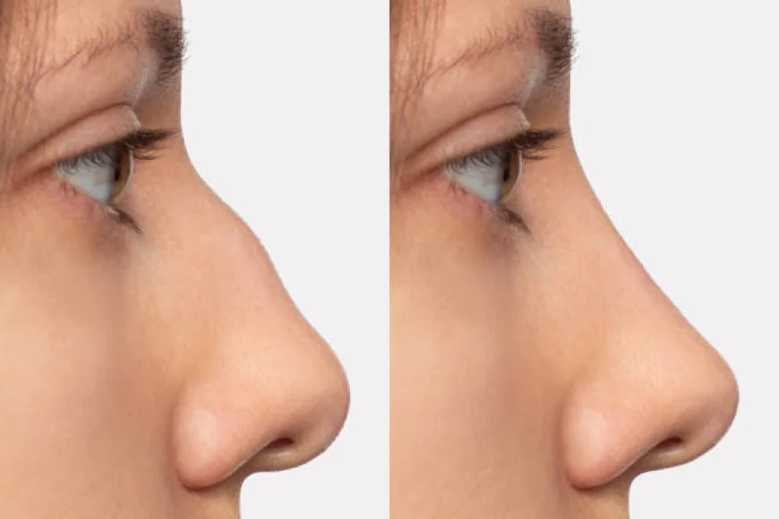 Combining Rhinoplasty with Other Cosmetic Procedures
