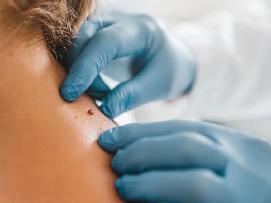 Understanding Skin Tag Growth Patterns and Prevention