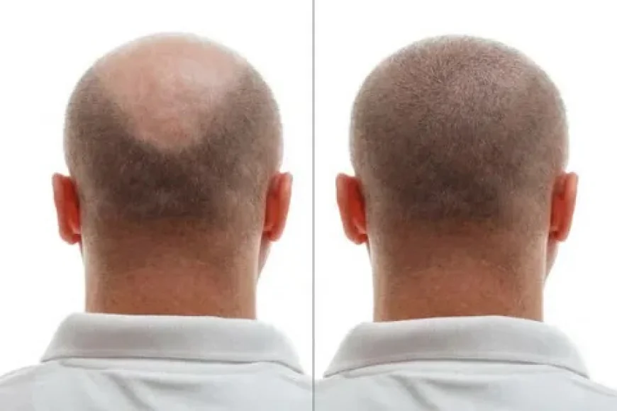 ? Everything you need to know about hair transplantation in Riyadh: Your comprehensive guide to amazing results