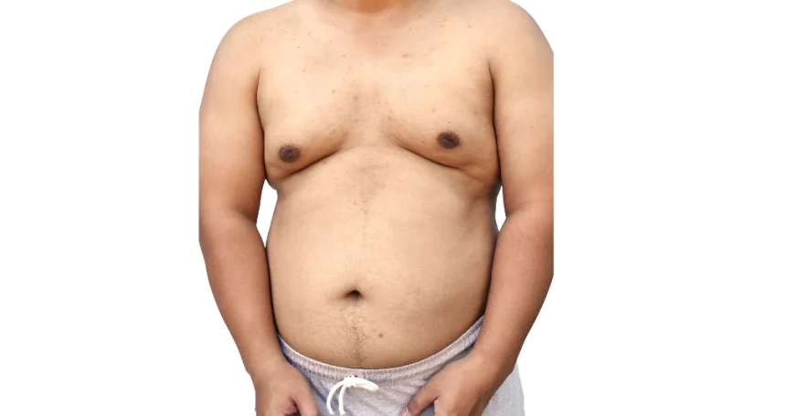 What’s the Difference Between Gynecomastia and Chest Fat?