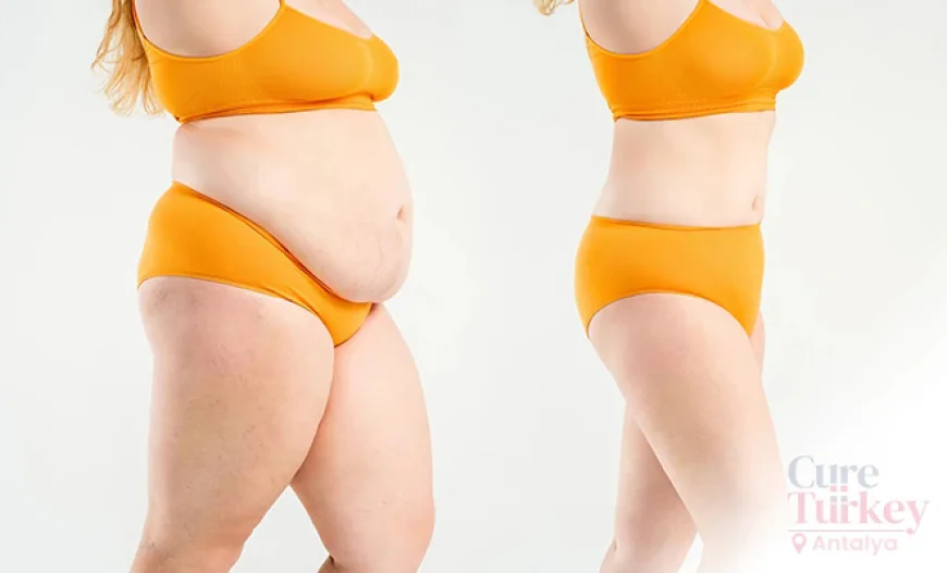 Tummy Tuck Turkey All-Inclusive package: Sculpt Your Dream Body with Expert Care