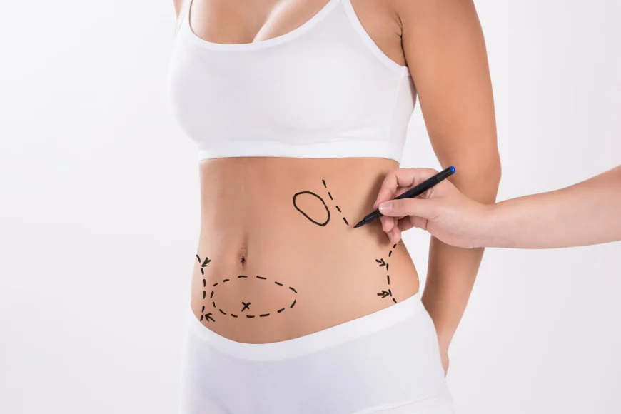 Traditional vs. Laser Liposuction – Which Is Better?
