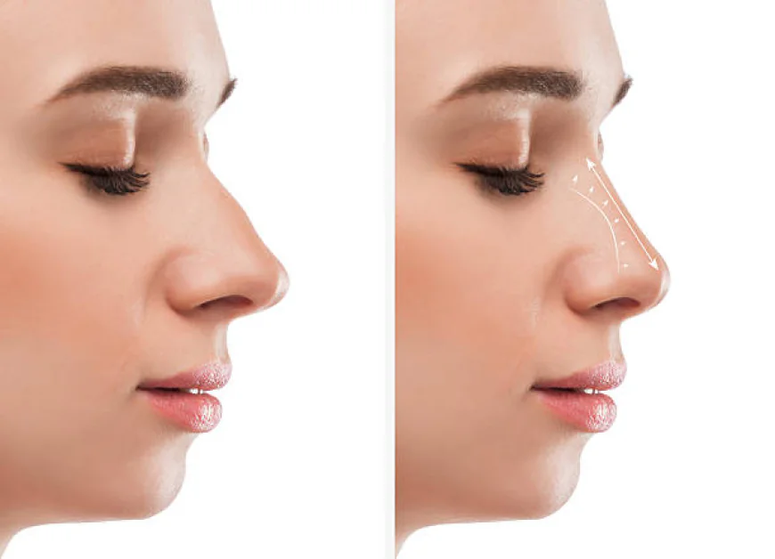 Different Rhinoplasty Techniques: Which Is Right for You?