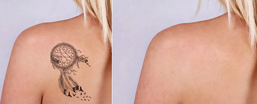 Laser Tattoo Removal Techniques and Technology