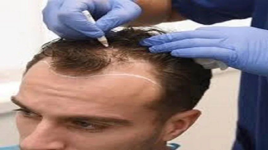 ? Hair transplantation in Riyadh: The ultimate solution to baldness
