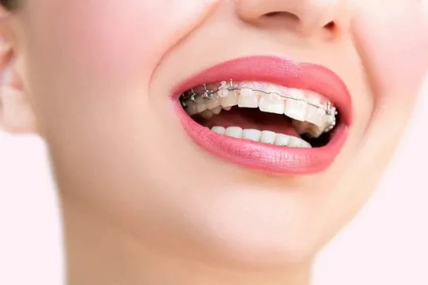 Painless Braces Treatment in Islamabad | Easy Installments