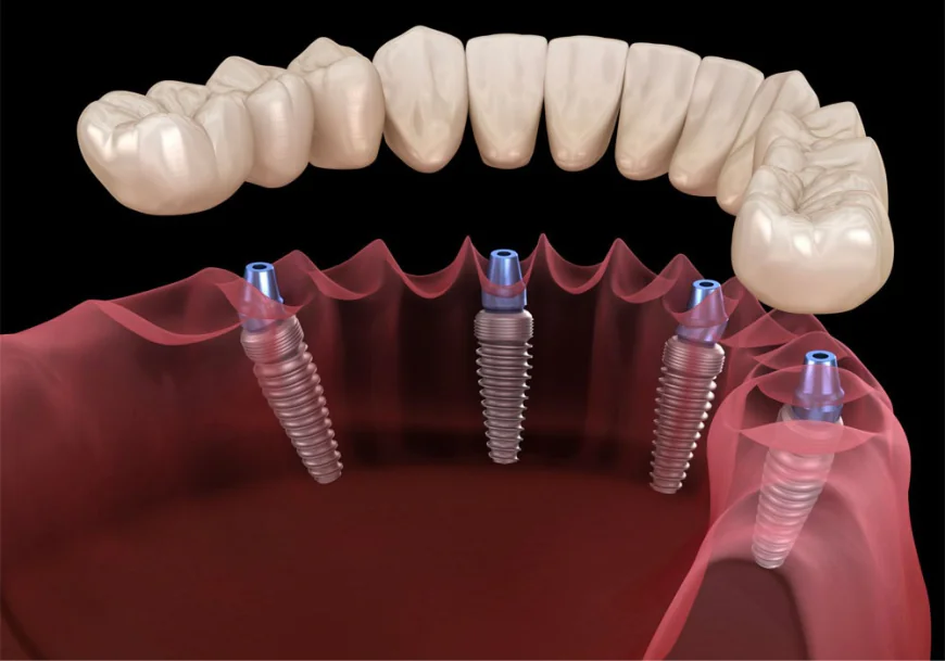 Who Is an Ideal Candidate for Full Arch Dental Implants?