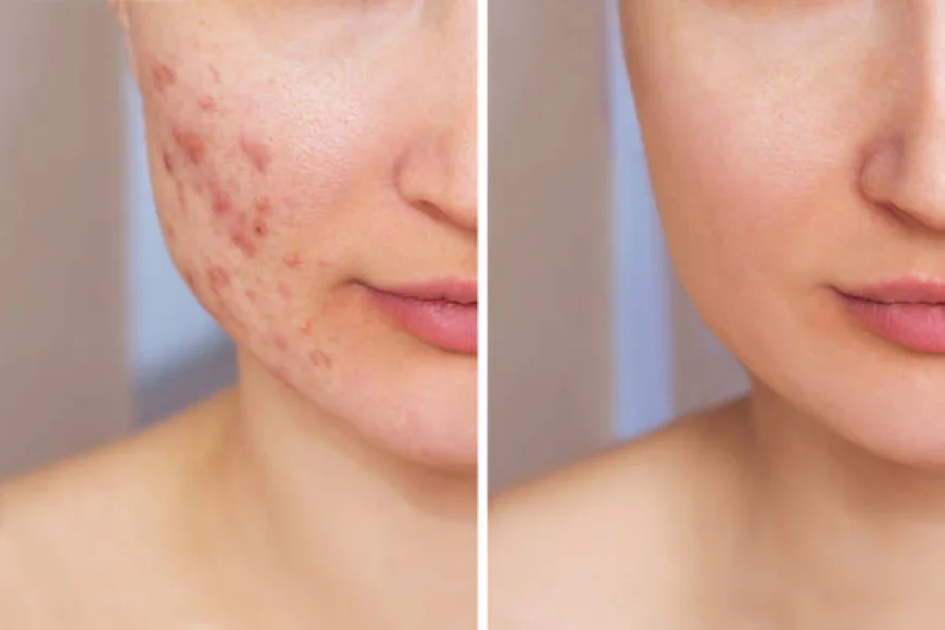 Pimples Treatment Using Advanced Skin Therapies