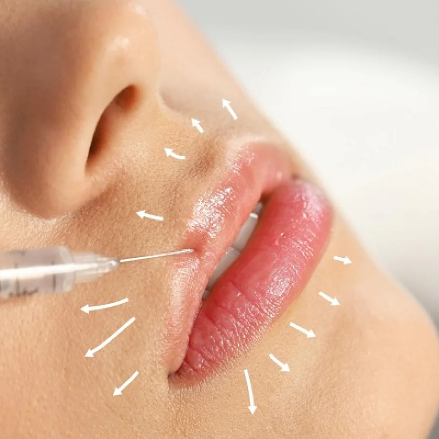 How Long Do Lip Filler Injections Last? A Complete Guide