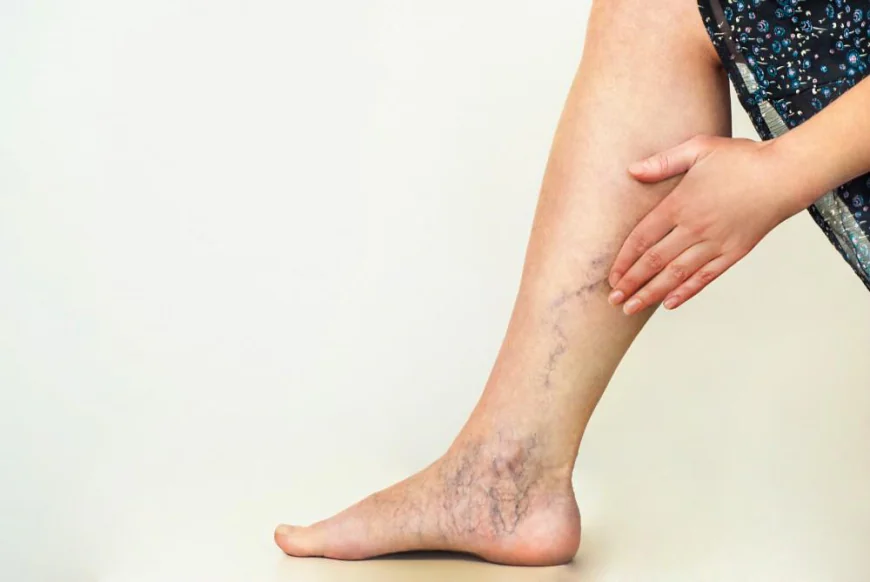 Find Relief from Venous Insufficiency Symptoms in Edinburgh