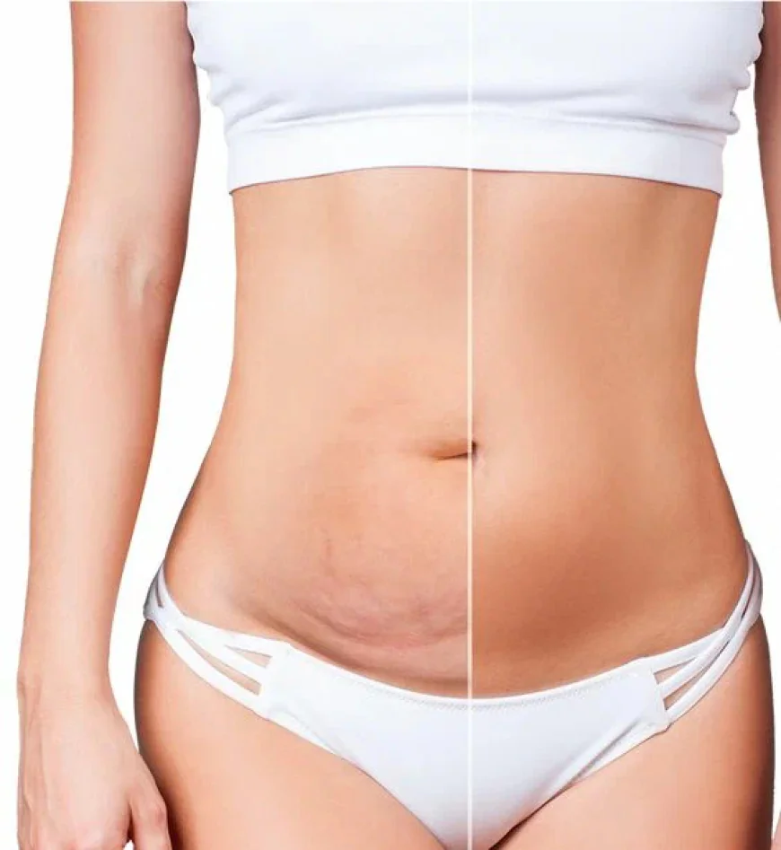 Transform Your Body with Safe and Effective Liposuction in Islamabad