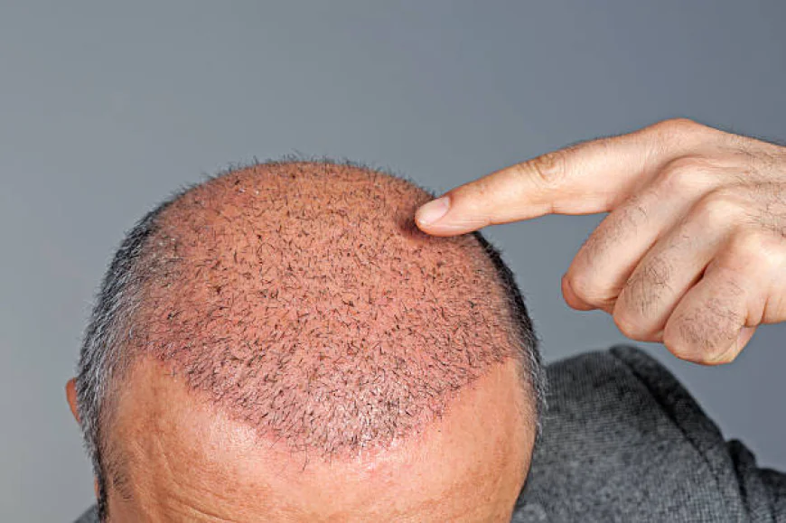 Hair Transplant: Your Path to Natural Regrowth