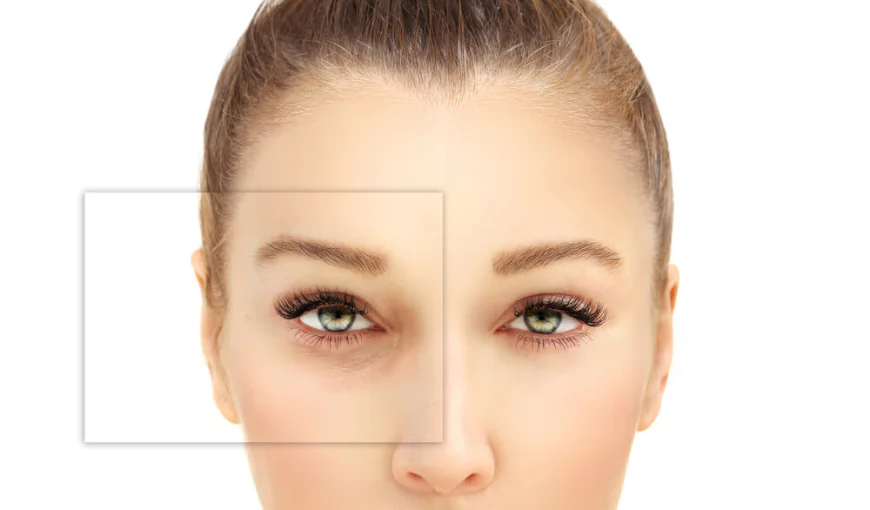 Best Age for Blepharoplasty: Advice from Islamabad Surgeons