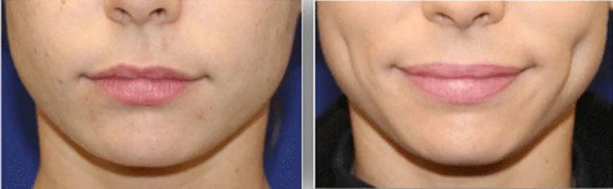 Dimple creation for men in Islamabad