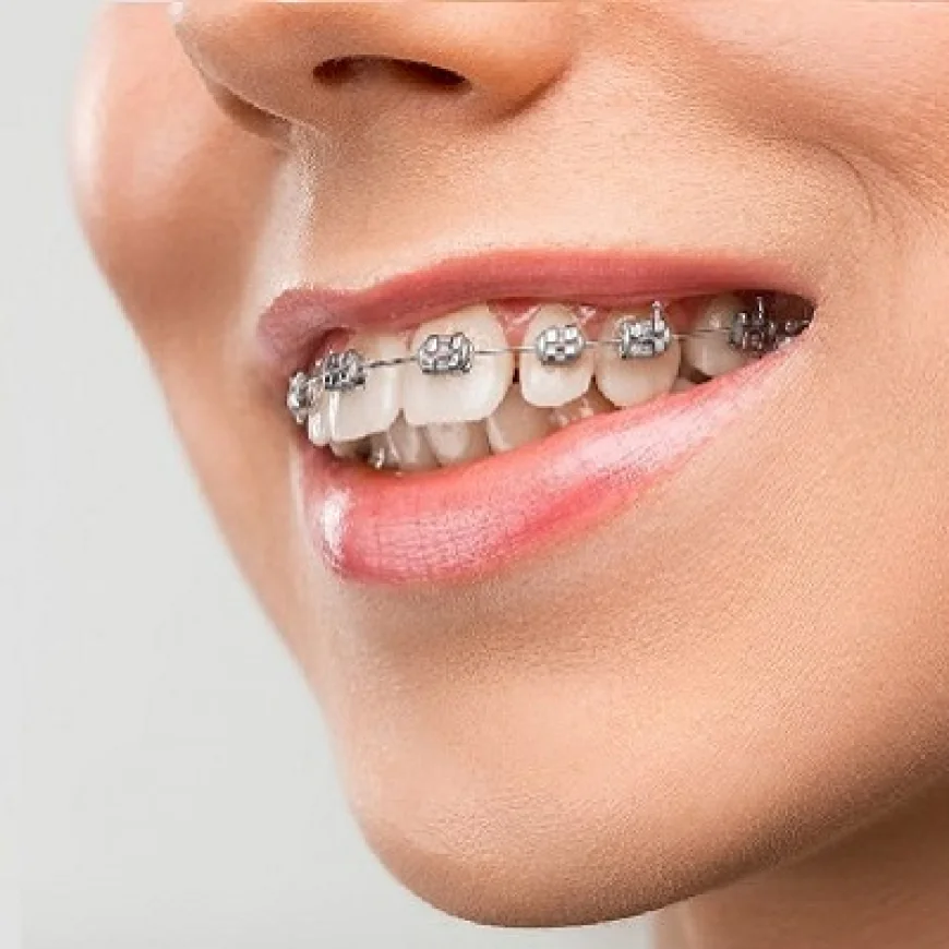 Adult Braces: Boosting Confidence and Your Smile