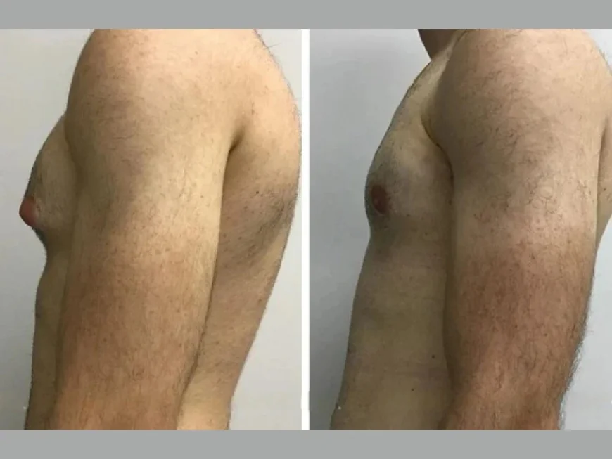 Best Gynecomastia Doctors in Dubai Combining Art and Surgical Skill