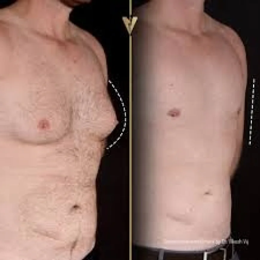 Insurance and Gynecomastia in Dubai: What’s Covered and What’s Not