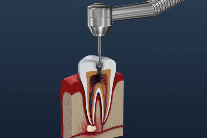 What to Expect During a Root Canal in Islamabad