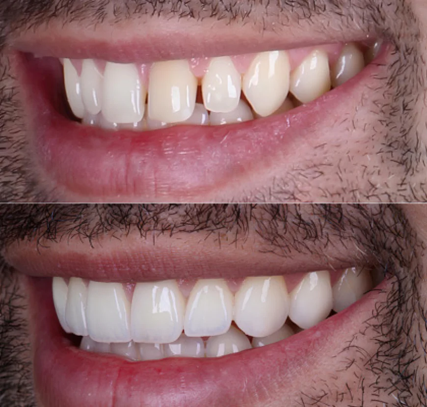 E-Max Veneers vs. Composite Veneers: Which Is Better?