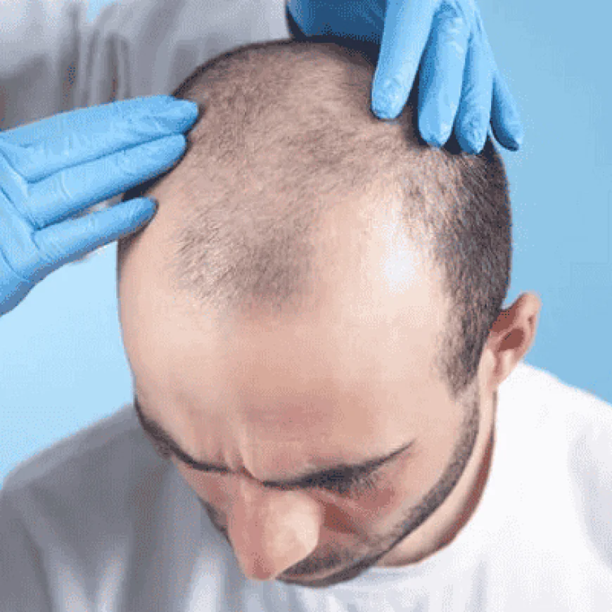 Choosing a Hair Transplant Surgeon: Key Questions to Ask