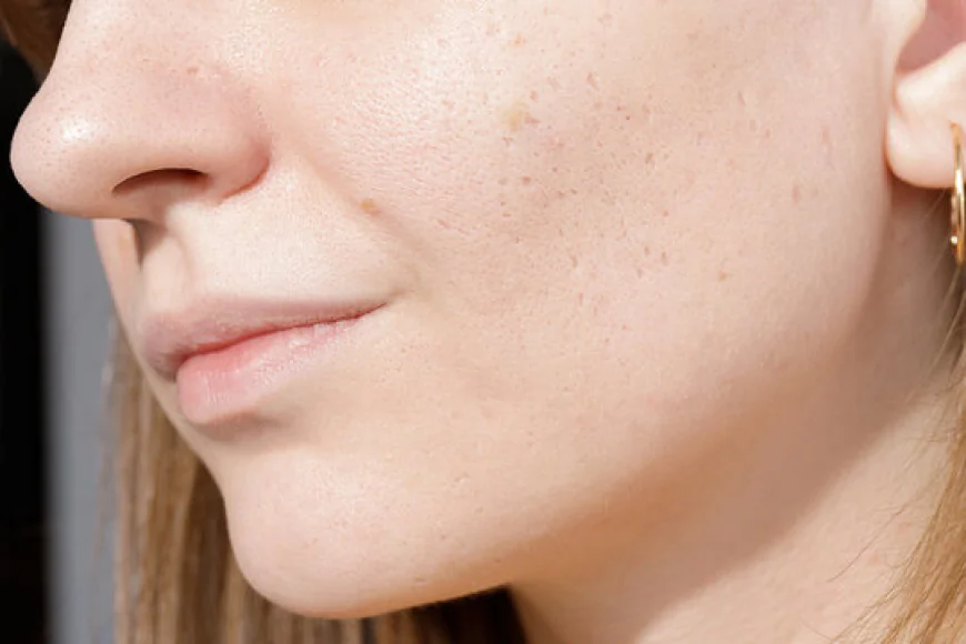 Restore Your Skin: Top Acne Scar Treatments in Islamabad