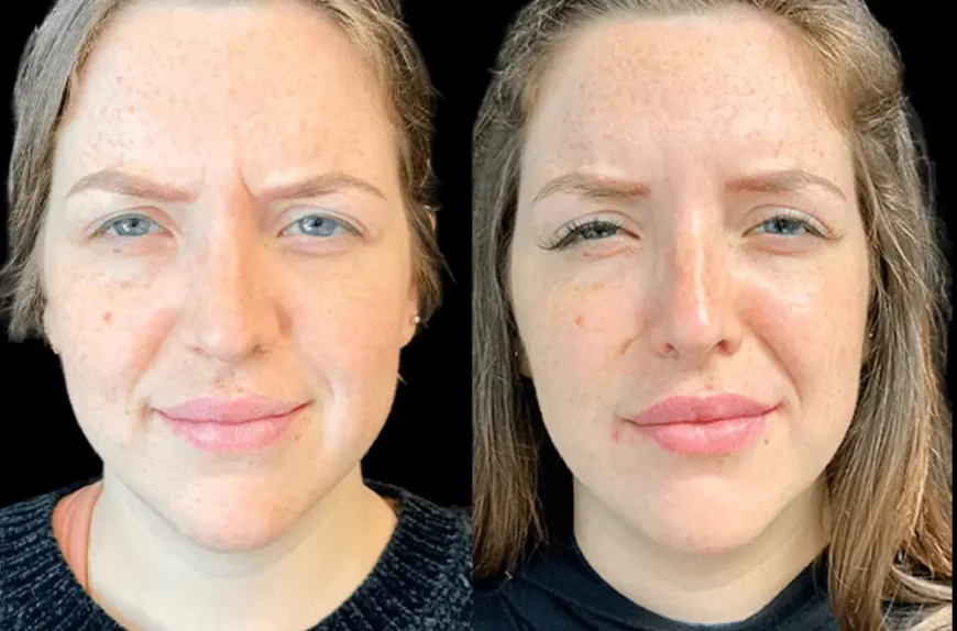 How the Best Plastic Surgeon in Dubai Customizes Botox for Facial Harmony