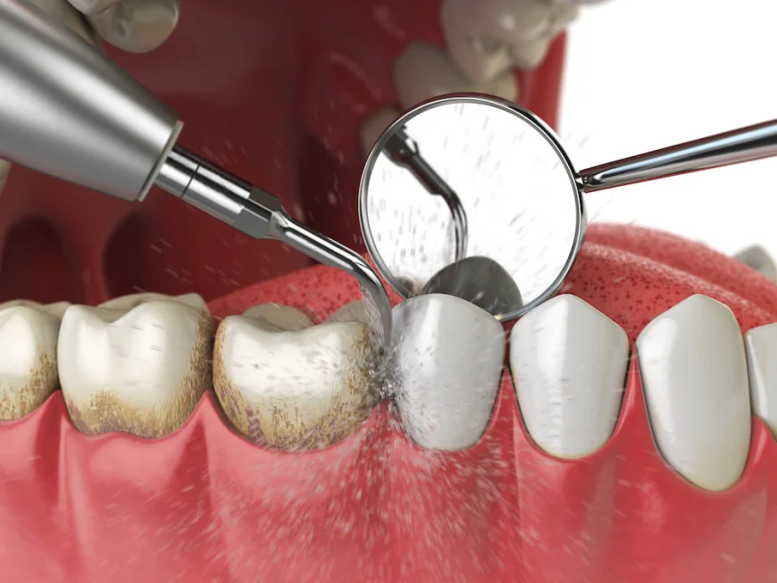 How Often Should You Schedule Teeth Cleaning in Dubai?