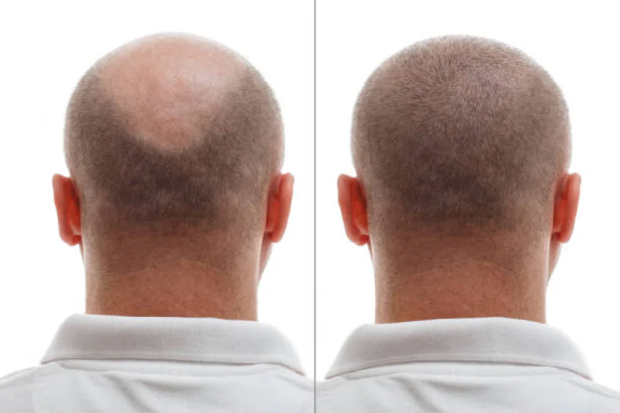 Hair Transplant Preparation Tips for Best Results