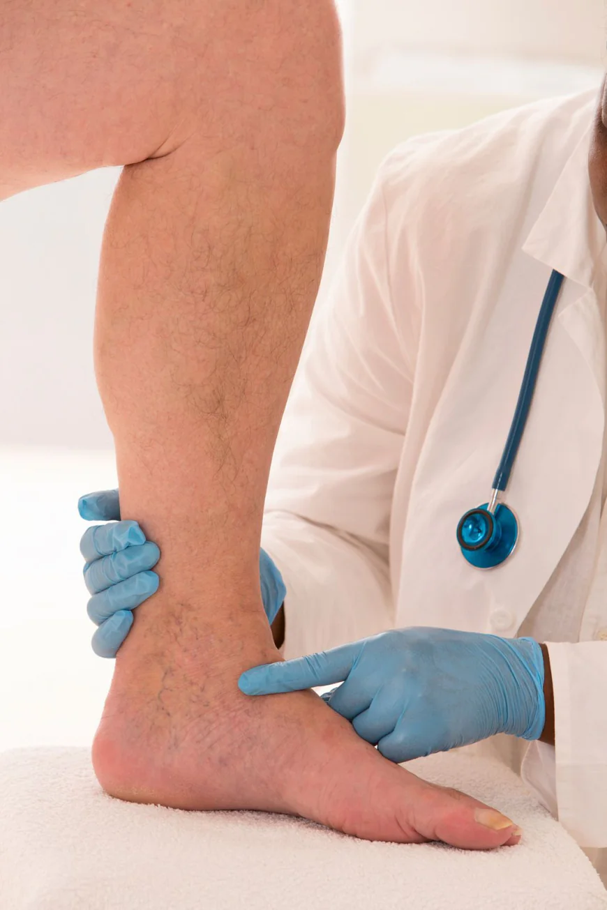 Can Weight Loss Reduce the Severity of Varicose Veins?
