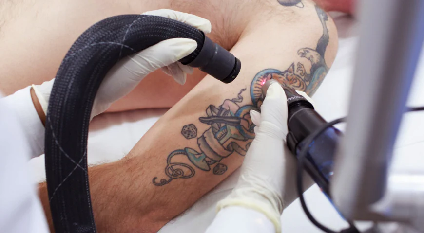 How Many Sessions Are Required for Full Tattoo Removal?