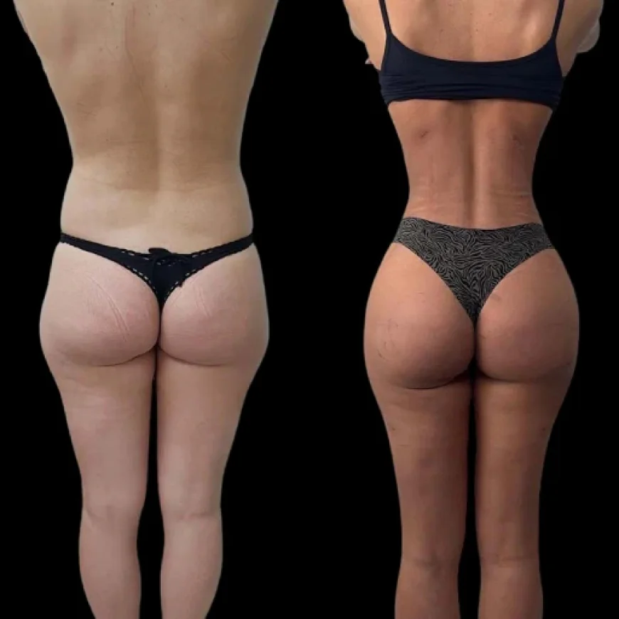 Choosing the Right Clinic for J-Plasma in Dubai